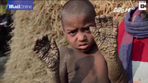 Xót xa cậu bé 8 tuổi có cơ thể đang dần hóa đá