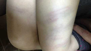 Cô giáo mầm non ở Thanh Hóa dùng đũa đánh thâm đùi trẻ 2 tuổi