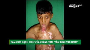 Đám cưới hạnh phúc của chàng trai 'cằm dính vào ngực'