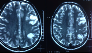 Nha Trang: Phát hiện bệnh nhân mắc nhồi máu đa ổ bán cầu não hiếm gặp
