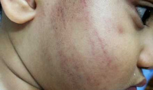 Cô giáo mầm non Đồng Nai tát trẻ thâm tím mặt