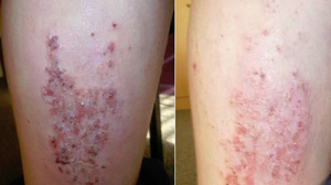 Điều trị viêm da cơ địa mạn tính bằng Dr Michaels Dermatinex thảo dược