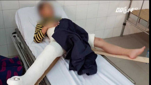 Học sinh gãy chân khi chơi trong sân trường: Hiệu trưởng và tài xế mỗi người nói một kiểu