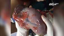 Hy hữu: Bé gái chào đời vẫn còn nguyên túi ối ở Nghệ An