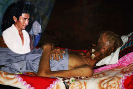 Người đàn ông mắc bệnh lạ bị ăn hết khuôn mặt từng giấu mình 5 năm và có ý định tự tử