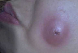 Cắt má lúm đồng tiền, lúm đâu chả thấy, thấy má bưng đầy mủ