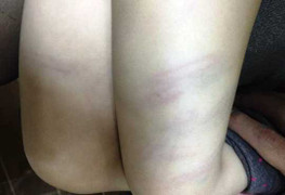 Sa thải cô giáo mầm non Thanh Hóa dùng đũa đánh thâm đùi trẻ 2 tuổi