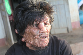 Những cơn đau tột cùng của 3 cha con mang căn bệnh 'mặt quỷ' quái ác