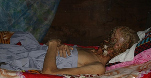 Người đàn ông bị bệnh lạ ăn hết khuôn mặt ở Tiền Giang đã qua đời