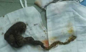 Phát hiện búi tóc khổng lồ, dài nửa mét trong bụng bé gái 7 tuổi