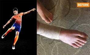 Cận cảnh chấn thương khiến Xuân Trường không thể lên tuyển Việt Nam