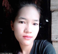 Biến chứng sau khi nhổ răng, thiếu nữ xinh đẹp thành người 'không mặt'