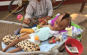 Xót xa cậu bé 6 tuổi bị nứt đôi đầu không rõ nguyên nhân