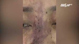 Tiêm chất làm đầy ở viện thẩm mỹ, hỏng má, hoại tử chân mày