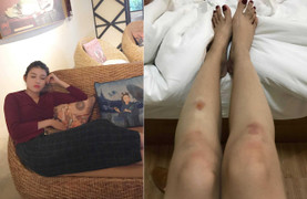 Á hậu Huyền My thiếu ngủ, ngã bầm dập đầu gối khi đóng phim ở Myanmar