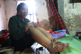 Người đàn bà chân voi kỳ lạ và gia đình toàn người lùn ở Hưng Yên