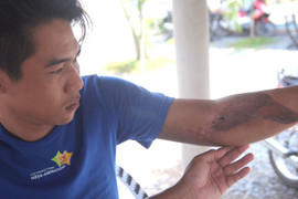 Công an xã bị tố đánh gãy tay nam thanh niên