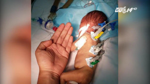 Bác sĩ căng mình trong ca mổ tim cho bé sơ sinh nhỏ bằng bàn tay