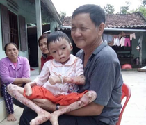 Xót xa bé gái 8 tuổi mắc bệnh lạ chân tay không có ngón, cơ thể phồng rộp, lở loét