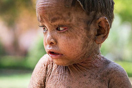 Xót xa bé gái có 'làn da thằn lằn' ở Ấn Độ