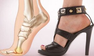 Đừng đánh đổi sức khỏe bằng sở thích đi giày cao gót