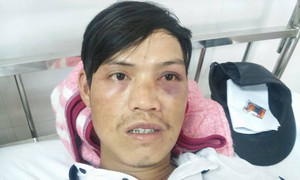 Dân tố bị đánh nhập viện, công an nói 'tự đập đầu xuống bàn'