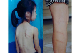 Bé gái lớp 1 bị cô giáo đánh thâm tím vì không làm được bài