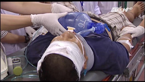 Trèo cây sấu hái quả, ngã chấn thương sọ não