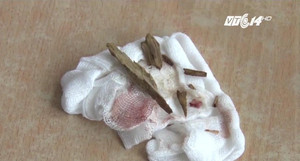 Dùng thanh gỗ đánh nhau, bị dằm 6cm đâm vào mắt