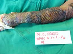 Độc đáo cách chữa bỏng bằng da cá rô phi ở Brazil