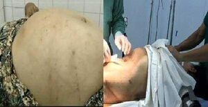 Tưởng béo bụng, đi khám mới phát hiện khối u gần 20kg trong người