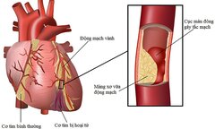 Ăn uống tốt, người khỏe mạnh… bỗng chốc 'sống chung' với bệnh?