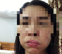 Hà Nội: Làm má lúm đồng tiền, mặt méo xệch đáng sợ