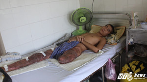 Đau xót thiếu niên bị bạn đùa giỡn, máy bào cuốn nát đôi chân