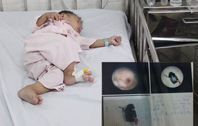 Nuốt nhầm bọ cánh cứng, mẹ xử lý sai khiến bé 8 tháng tuổi suýt mất mạng