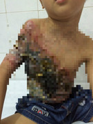 Bị bỏng suýt tàn phế, bé trai còn bị thầy lang chiếm hơn 100 triệu đồng tiền từ thiện