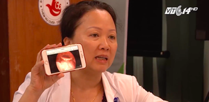 Nuốt xương cá khi ăn cơm, 20 ngày sau suýt mất mạng