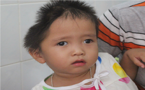 Xót xa bé gái 30 tháng tuổi mang 2 căn bệnh quái ác, đầu bị móp một bên