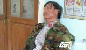 Trưởng công an xã đánh vỡ đầu dân: Kết luận bất ngờ