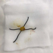 Nam thanh niên nuốt chửng 2 cọng kẽm, thủng 5 lỗ ở ruột