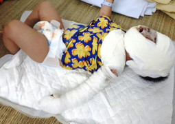 Thương tâm bé gái 9 tháng tuổi ngã vào bếp lửa khiến mặt biến dạng