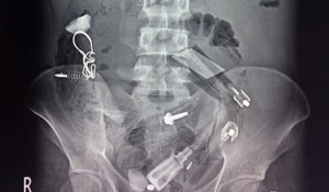 Lấy hàng loạt bút bi, bật lửa, lò xo trong bụng bệnh nhân ngáo đá