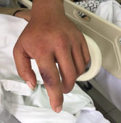 Mải chữa vết rắn cắn bằng thuốc nam, đến viện đã tử vong