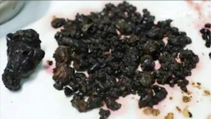 Nhịn ăn sáng 10 năm, bụng chứa hơn 200 viên sỏi mật