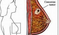 Cách nhận biết ung thư vú đơn giản nhất ai cũng nên biết