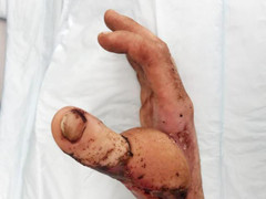 Cận cảnh bác sĩ bệnh viện Xanh Pôn chuyển đốt ngón chân thành... ngón tay