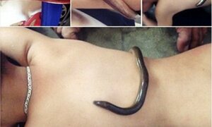 'Đỉa hút mụn, lươn hạ sốt' những kiểu chữa bệnh phát khiếp của mẹ Việt