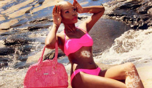 Mắc căn bệnh lạ, nữ sinh 9X người Mỹ vẫn tự tin diện bikini trước đám đông