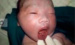 Kỳ lạ: Em bé vừa chào đời đã mọc răng cửa