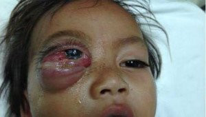 Bé trai 16 tháng tuổi mắt sưng như quả trứng gà vì viêm xoang gây biến chứng